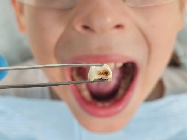 Best Emergency Wisdom Tooth Extraction in Wellston, MO